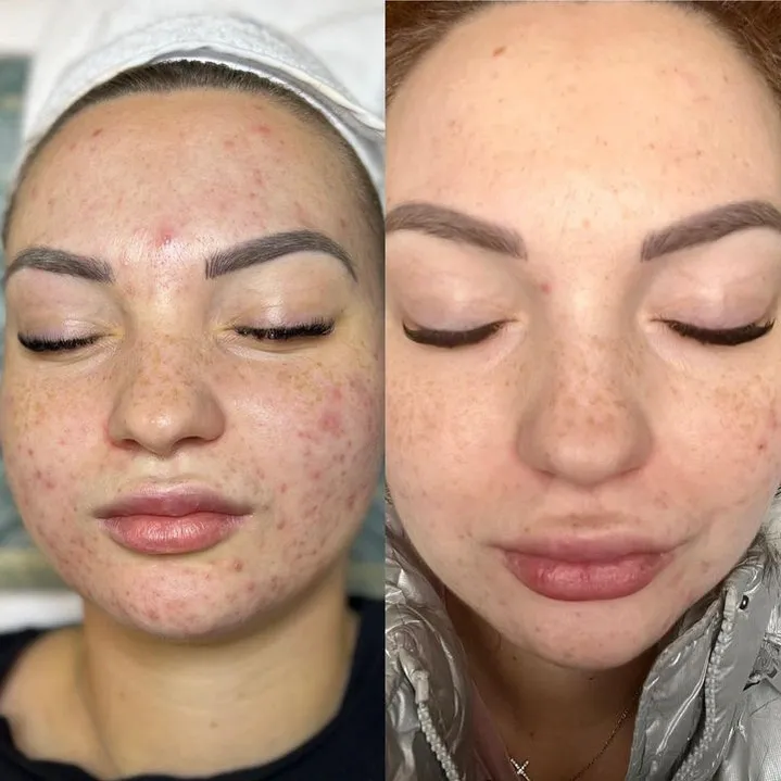 Acne treatment before and after results in Boston