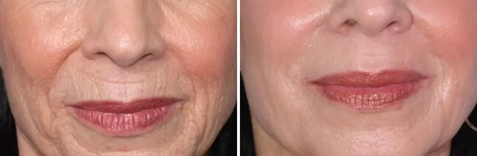 Fine lines and wrinkle treatment before and after results