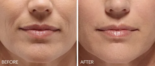 Lip rejuvenation before and after results in Boston