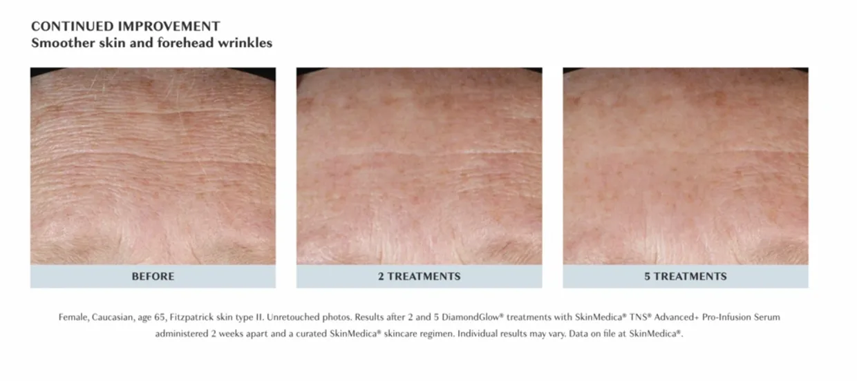 DiamondGlow facial and skin rejuvenation results in Boston