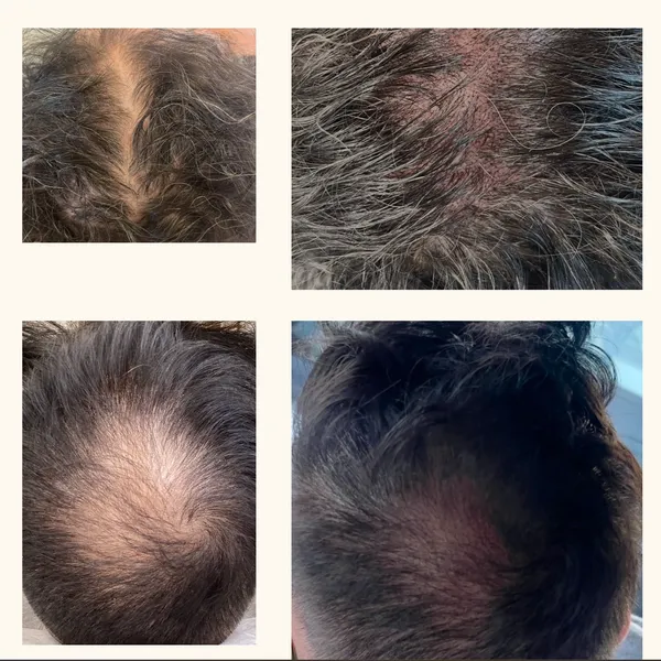 Scalp micropigmentation before and after results in Boston